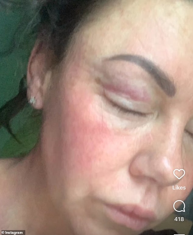 Looking back: The singer shared some heartbreaking snaps showing her with a bruised face after 