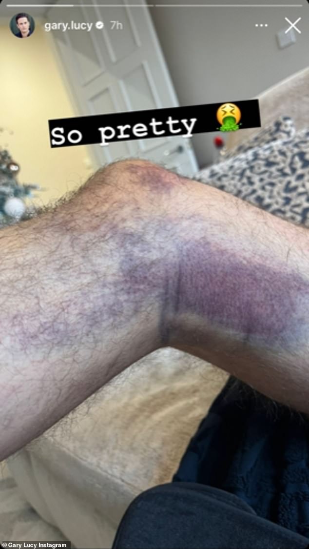 'So pretty': The Celebs Go Dating star, who is in a new relationship with Love Islander Laura, shared a photo of her injuries with her followers on Friday