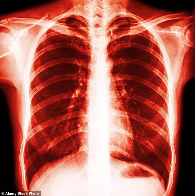 Latest figures from Cancer Research UK show that, while men account for most cases of mesothelioma, cases among women rose by 93 per cent between 1993 and 2018 (compared with 47 per cent in men)