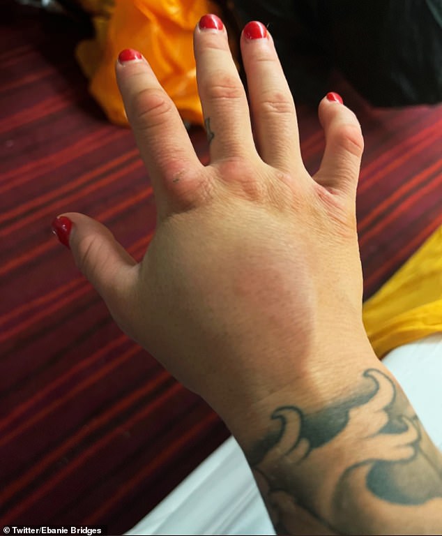 Bridges' hand pictured after the championship match with Shannon O'Connell