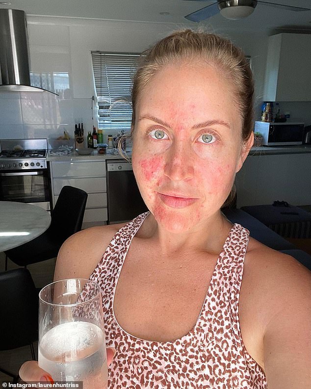 The 34-year-old revealed that she has been battling severe skin breakouts for some time.