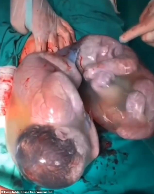 Twins Maria Cecilia and Maria Alice inside their amniotic sacs after a C-section in the Hospital de Nossa Senhora das Dores in Ponte Nova, Brazil, June 11, 2022