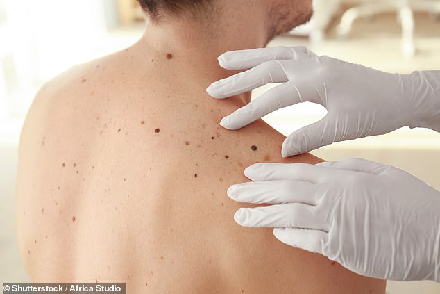 Mr Chalmers encouraged Australians to get regular skin checks (above) to eliminate dangerous skin cancers before they get worse