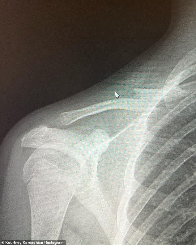 Mystery: An X-ray showed a dislocated shoulder bone;  however, it is not clear whose it is