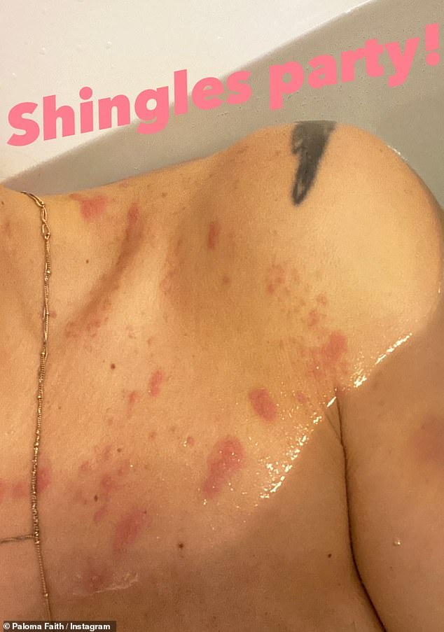 Ouch: Paloma shared a photo of her shoulder to show off the shingles rash to her 732,000 followers and wrote 