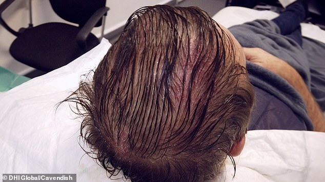 Phil Tuftnell! Cricket legend 'Tuffers' gets hair transplant to turf over  his 'thinning wicket'