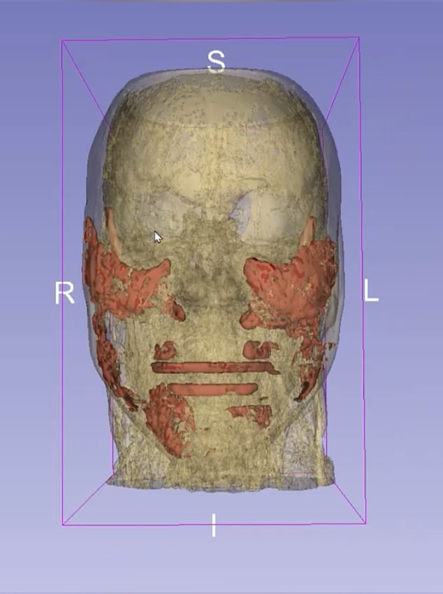 The MRI scan shows filler in the patches across her cheeks, jawline, chin, eyes, in her nose-to-mouth lines and lips