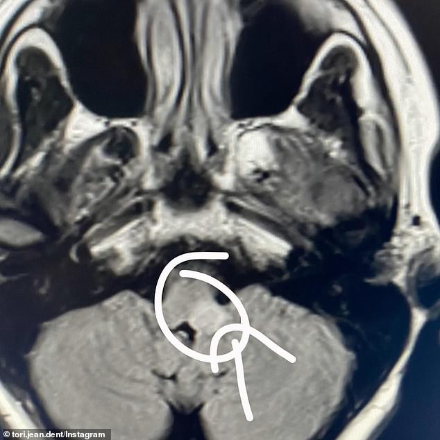 An MRI showed that Ms Dent had an abnormal growth on her brain