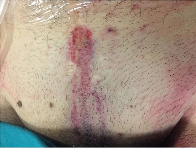 He also had burnt skin and hair in his pubic area (pictured), which medics believed was caused by the white hot bike frame hitting him when he was struck