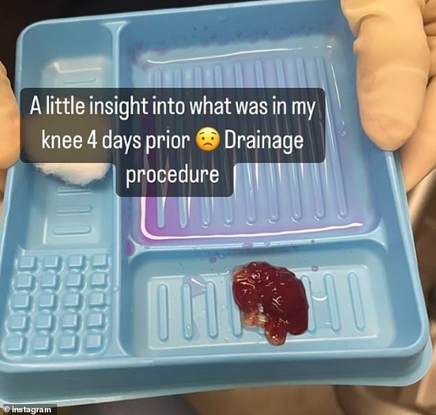 The Australian posted a grisly image of the fluid that had to be drawn from his knee with a syringe as the clock ticked down to get ready for the Open.