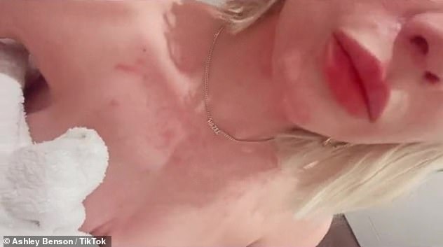 Skin condition: Comes after Ashley opened up about the effects of her mental health issues in a new TikTok video