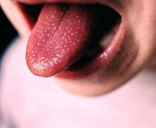 1673973658 378 What does YOUR tongue say about your health White patches