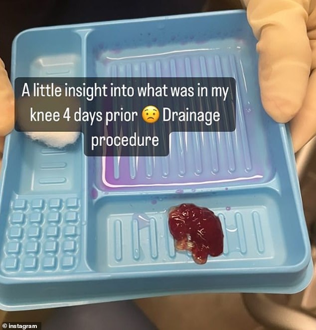 Kyrgios posted a grisly photo of what was drained from his injured knee with a syringe shortly after his Grand Slam retirement from home.