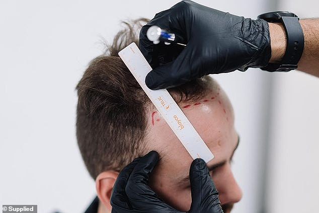 Problem: Sam said that the comments would make him feel insecure about his hair, so he decided to explore his options.  (Pictured by Hair Doctors Australia measuring his forehead)