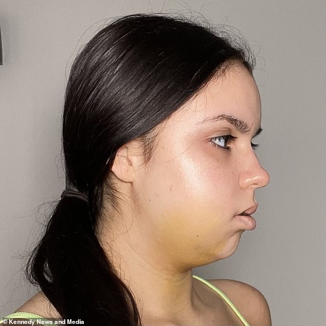 After surgery in March 2022, Jordan, who is a beauty connoisseur, was left with a bruised and swollen chin.