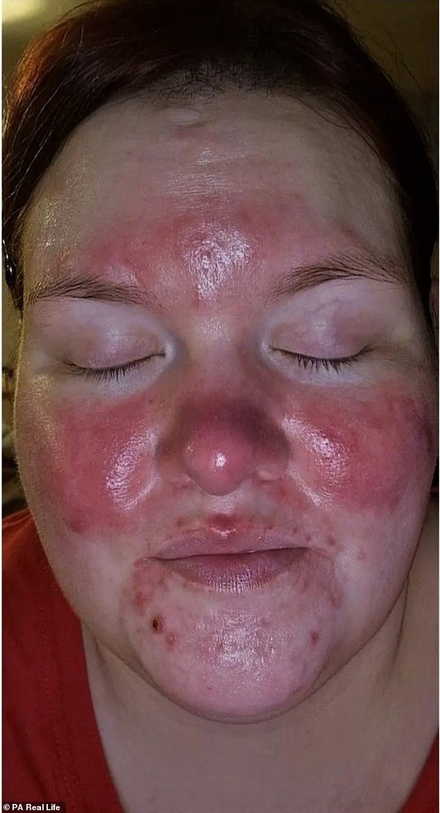 Natalie suffered from rosacea from a very young age, but after years of relentless bullying, strangers called her ugly.