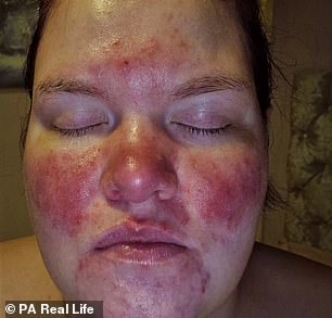 Meanwhile, a former partner was pushing her to get plastic surgery to 'get rid of rosacea', leaving Natalie's self-esteem at an all time low.