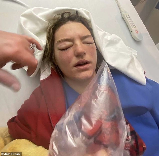 Samantha D'Aprile, 19, of Chicago, Illinois, was baking cookies with her mother in December 2021 when a bowl of scalding hot chocolate exploded in her face.  Her mother rushed her to the hospital, but she couldn't open her eyes for five days (pictured above at the hospital)