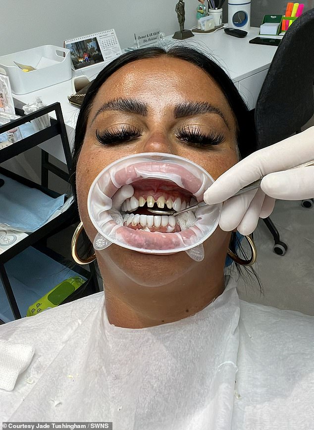 The procedure involved shaving the teeth before placing the new set of veneers over them (medium Jade procedure).