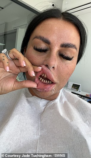 The couple then had to wait in the clinic reception for around five hours with their 'shark teeth' before dentists fitted each of them with temporary veneers (Jade pictured after having her teeth filed down)