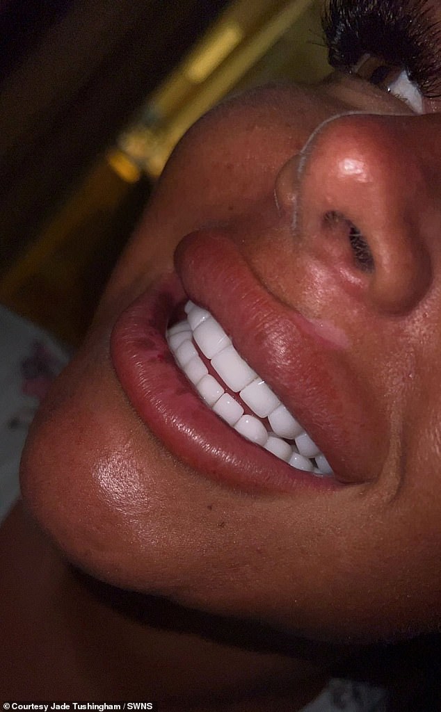 The temporary veneers, which they had to keep in place at all times, were said to be ill-fitting and similar to 