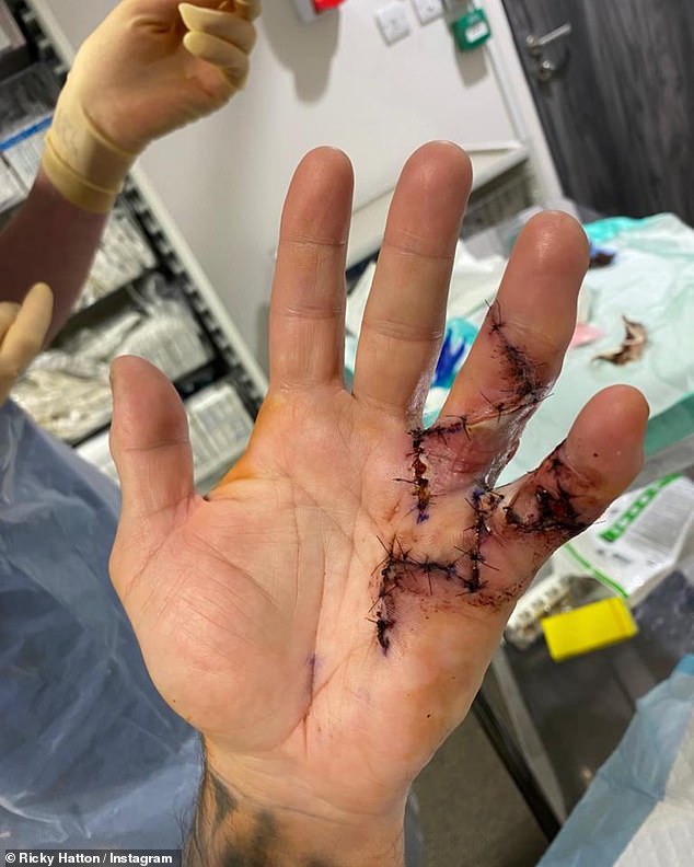 Oh!  The former professional boxer, 44, took to Instagram on Tuesday to show off his hand injury as he recovered from surgery, with Ricky noting that he had been a 