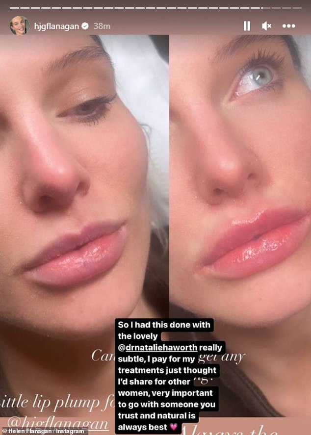 Pouty: While Helen's filler results are subtle, she did share a before and after transformation shot on her grid