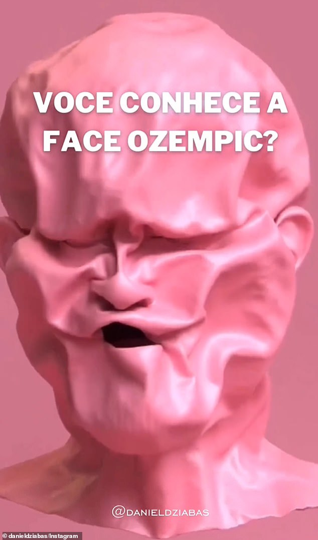 Dr. Daniel Dziabas Posts An Animation Of An 'Ozempic Face' Shrinking From Use Of The Drug