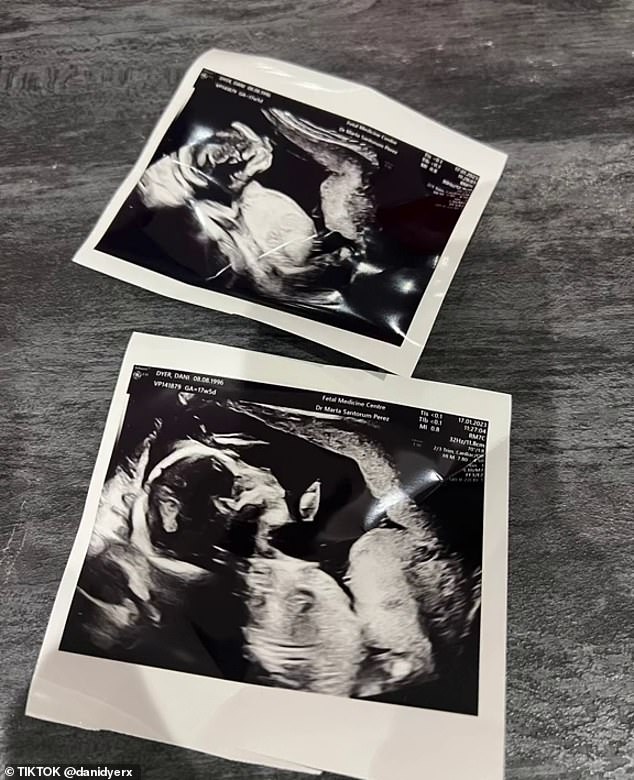 Identical: In a series of posts, she revealed she's having identical twins and shared she's five months pregnant next week as she hinted at her due date