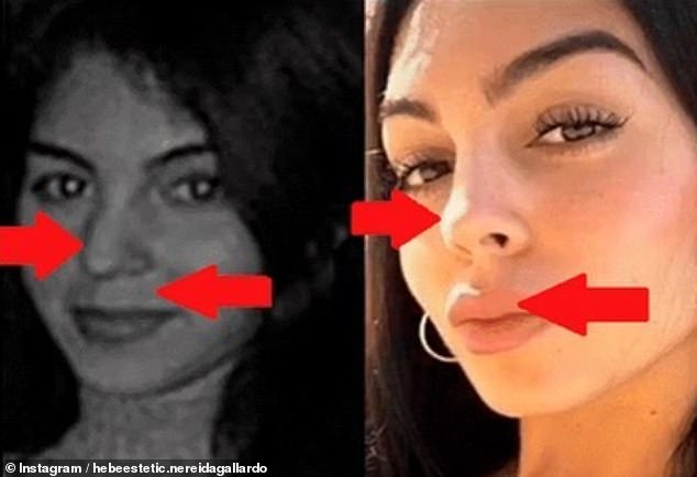 Nereida posted these photos of Georgina side by side and suggested that she has had some cosmetic work done on her nose and lips.  Georgina has never publicly confirmed if she has had any cosmetic procedures