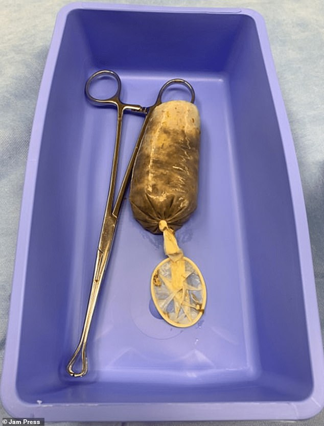 The patient underwent invasive surgery to remove the fruit, which doctors say was ultimately successful.  In the image, the obstruction wrapped in prophylaxis, shortly after its extraction.