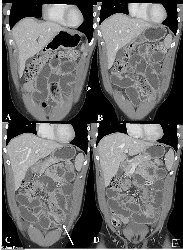 The medical journal Cureus published a case study detailing the case, writing how the first patient arrived at his Iowa hospital with symptoms of abdominal pain, nausea and vomiting.  Doctors only became aware of the blockage after doing these CT scans.