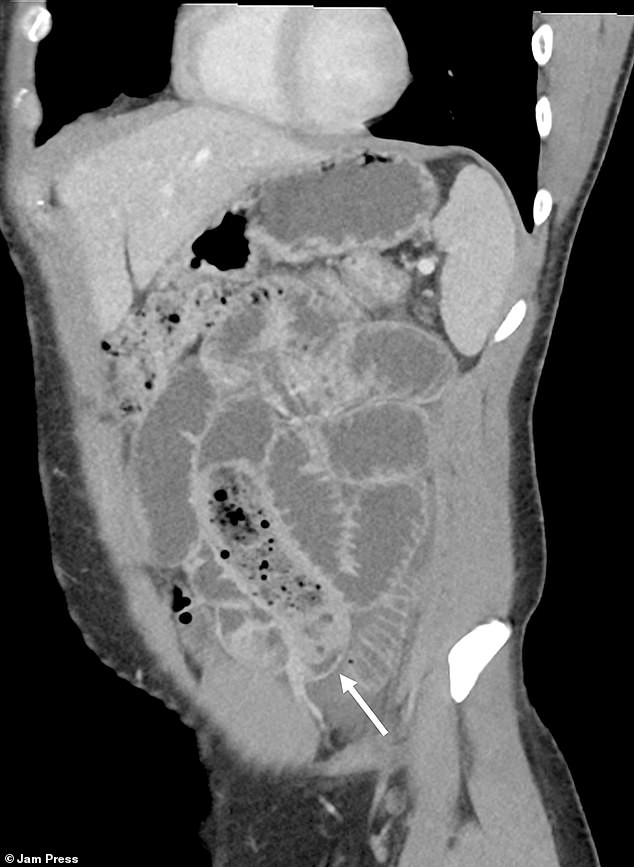 The bizarre case study, titled Banana in a Condom: An Unusual Cause of Small Bowel Obstruction, included post-operative photos showing the removed obstruction on a surgeon's table, as well as X-ray scans of the man.