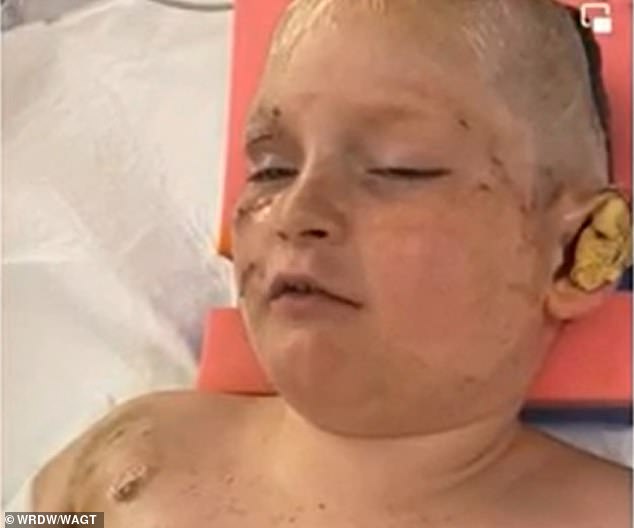 Justin Gilstrap, 11, of Appling, Georgia, underwent multiple surgeries after a pack of pit bulls attacked him Friday.