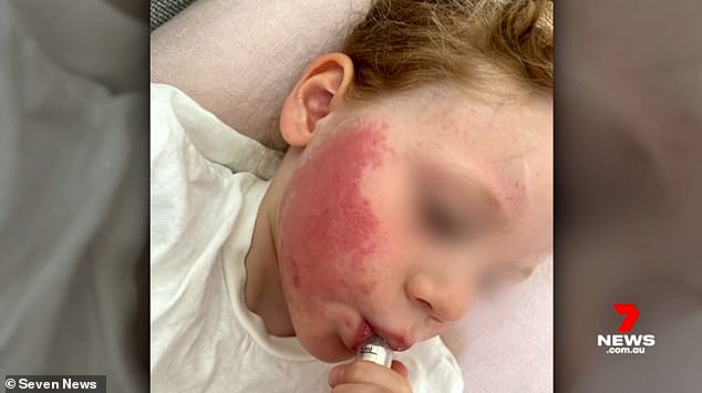 Images of the boy showed his face with bright red spots that looked like severe burn marks (pictured)