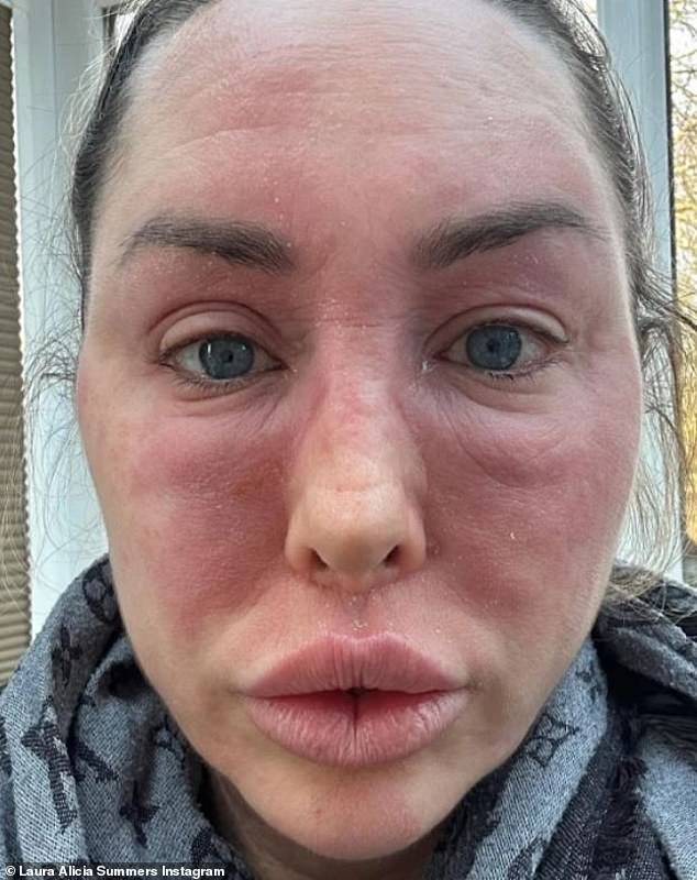 Shocking!  Ex On The Beach star Laura Alicia Summer was rushed to hospital on Monday after suffering a terrifying allergic reaction that left her struggling to breathe.