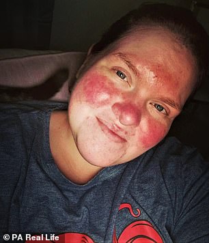 Natalie Rose, 33, from Shropshire, who was branded a tomato by a cruel workplace bully and told she was ugly by strangers because of her rosacea, has learned to love her skin again after finding skincare miraculous skin.