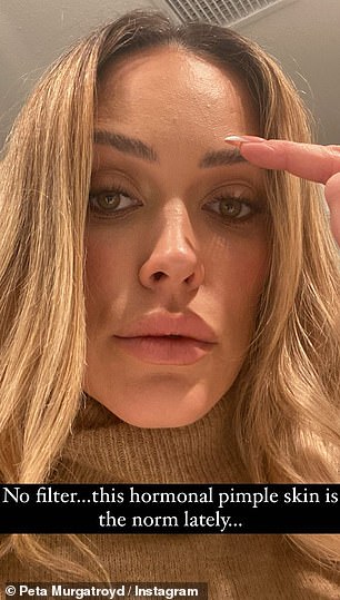 Unfiltered: Pregnant Peta Murgatroyd, 36, posted a candid photo to her Instagram Story on Monday, revealing her hormonal acne.  