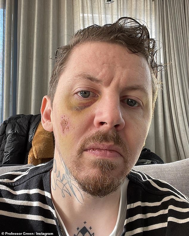 'My family almost lost me': Professor Green revealed he was rushed to hospital after suffering ANOTHER life-threatening seizure while sharing a photo of his facial injuries