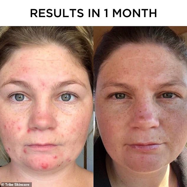 An all-natural skin care product that claims to 'dissolve' blackheads in as little as two weeks has hundreds of five-star reviews from satisfied customers.