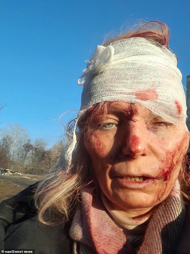 Photographs of Olena Kurylo's bandaged face were seen around the world in the early days of Vladimir Putin's invasion of Ukraine.