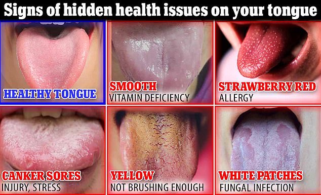 What does YOUR tongue say about your health White patches