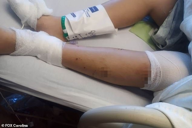 Hunter's legs are bruised and heavily bandaged after the attack