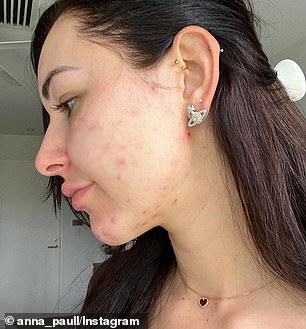 Before: The 24-year-old suffered from acne for years and on Monday she shared several photos on Instagram of what her skin used to look like