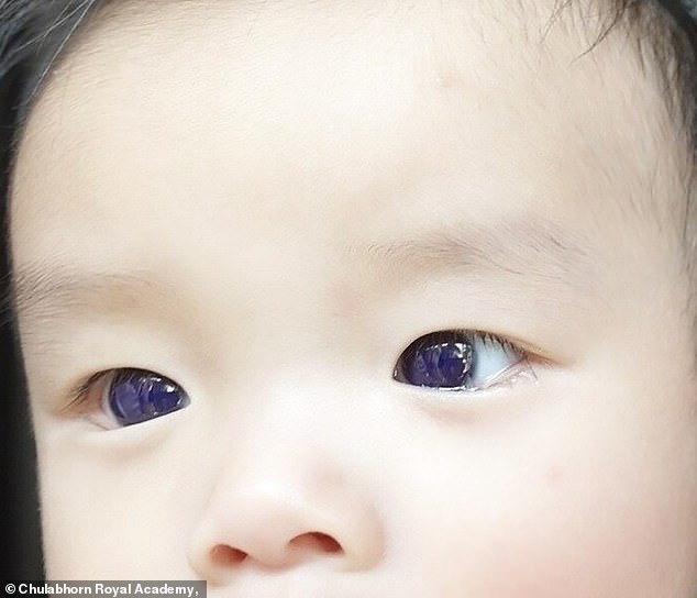 Within just 18 hours of the first dose, the boy's mother noticed his eyes turning a bright blue color