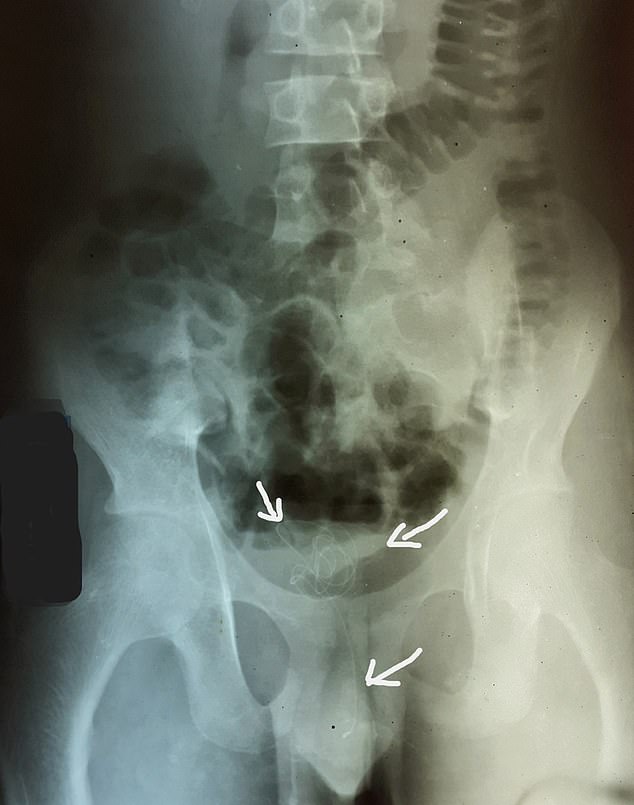 An X-ray of the man's pelvis showed an opaque foreign body in the pelvic cavity (marked on the scan) extending into the center of the urethra.