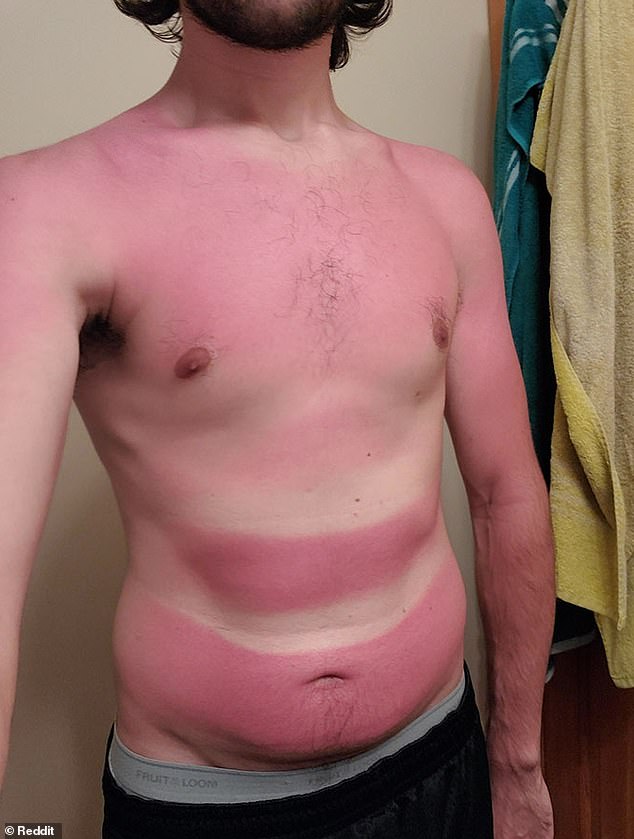 This holidaymaker went on a long kayaking trip that ended with the strangest sunburn