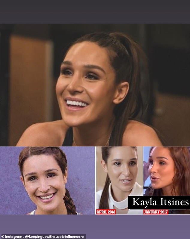 Kayla also looked unrecognizable in photos before she rose to fame as a fitness influencer.  It seems like she has a noticeably smoother nose and fuller cheeks these days, as well as fuller lips