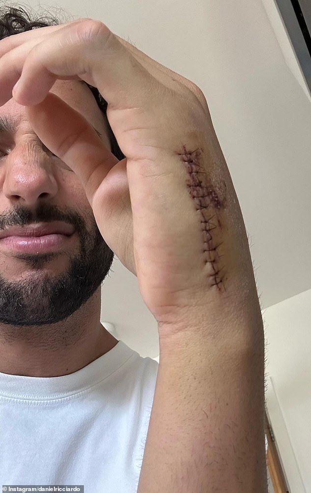 Ricciardo shows the aftermath of an operation in which he received 13 stitches