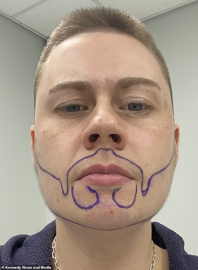 Surgery Group surgeons drew the beard shape Lee wanted on his face before beginning a grueling 12-hour skin graft surgery